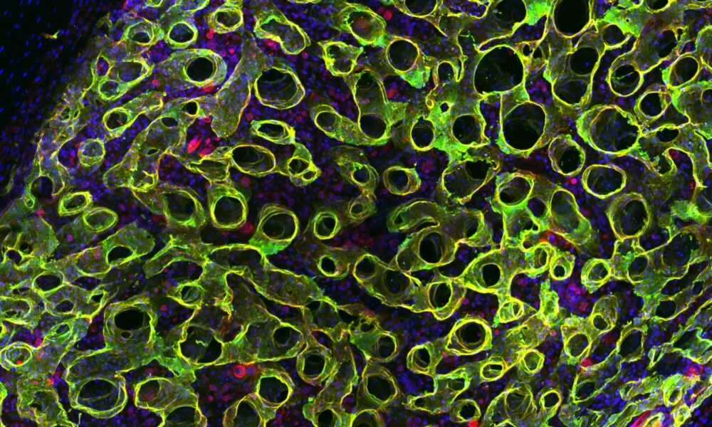 i3S inova no tratamento da leucemia mieloide aguda